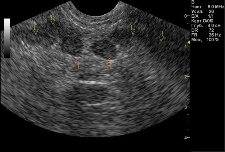 Prostatitis auf meinen Ultraschallergebnissen